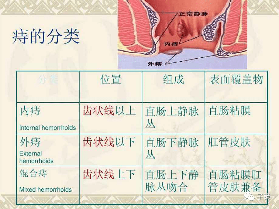 2019徐雷鸣教授“内镜下内痔泡沫硬化治疗”学习笔记_血管