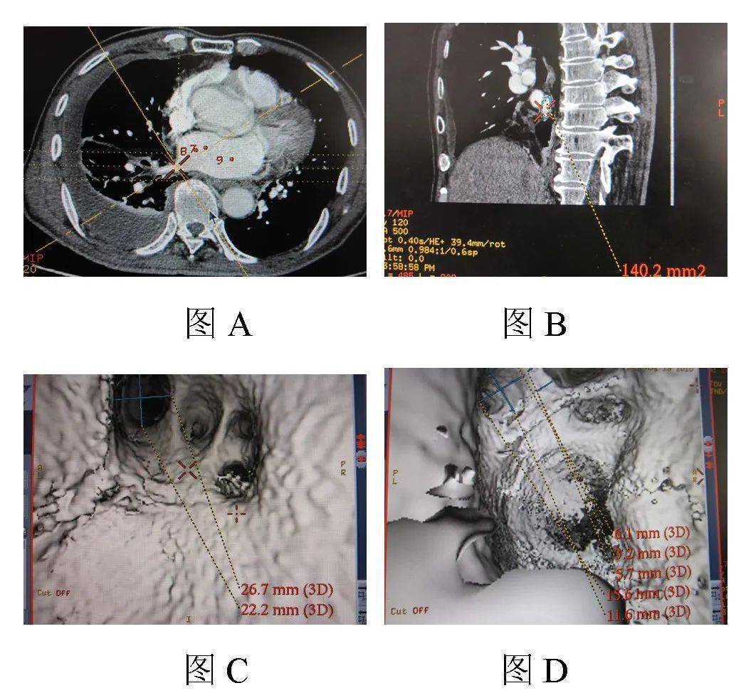 Ⅱ-66 左上肺静脉逆行造影(左前斜位45°)-介入治疗解剖学-医学