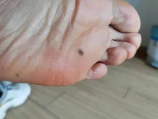 45,女,脚底黑色痣,1cm大小,表面平整光滑.对付黑色素瘤,预防是第一.