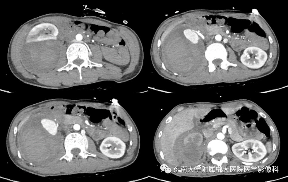 病史 男,46岁,因"外伤后右侧腰部疼痛1月"入院  ct 增强