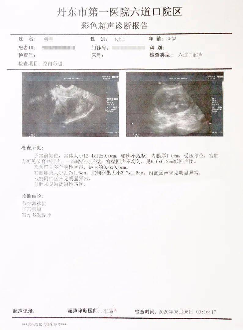 为瘢痕穿上隐形衣巨大子宫肌瘤在单孔腹腔镜下轻松切除