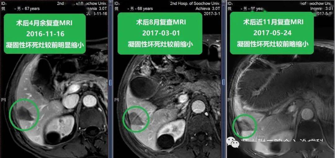 宫颈癌的哪8种症状表现出来_癌宫颈癌什么症状_癌宫颈有哪些症状