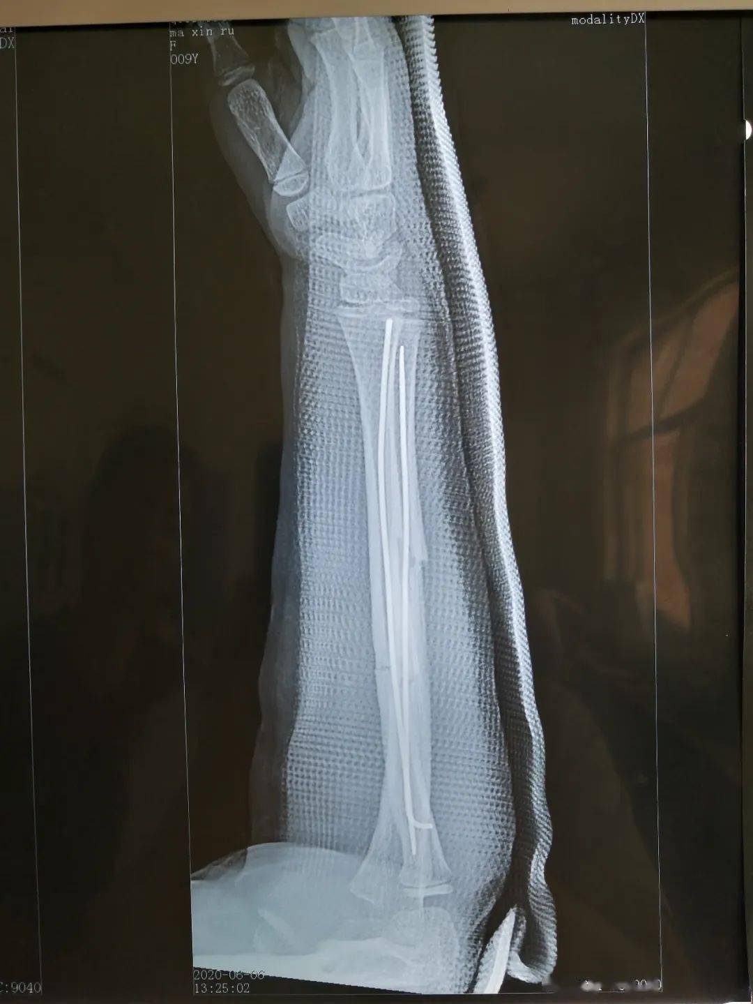 我院骨二科完成首例弹性髓内钉治疗儿童右前臂双骨折!