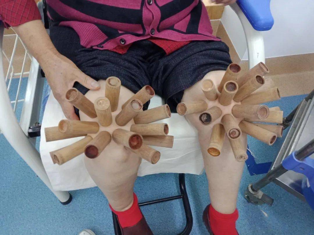 中医传统疗法平衡火罐这个夏天约起来