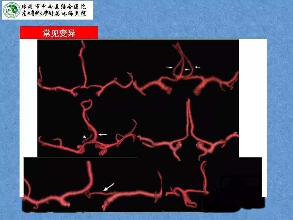 解剖影像頭頸部血管解剖及willis環常見變異