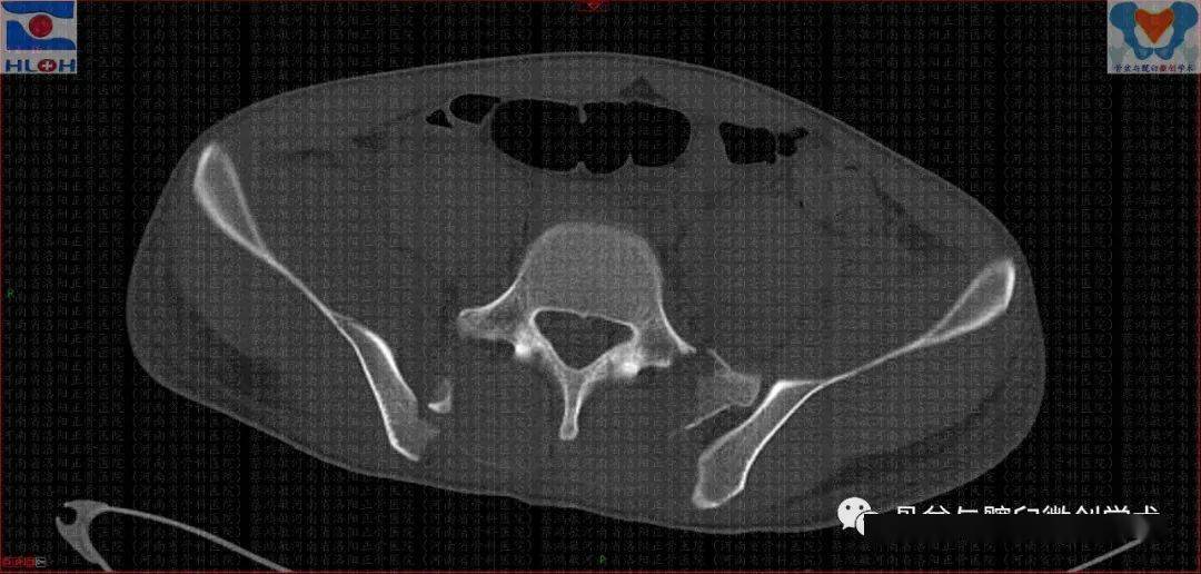 3 )(經骶骨左翼 denis2 區的垂直不穩定型骨折,經骶骨右翼壓縮骨折及