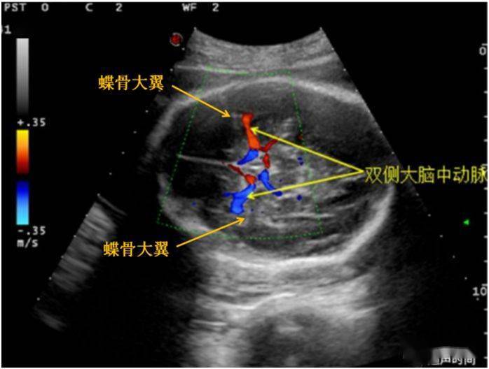 新手福利:胎儿大脑中动脉的测量和评估