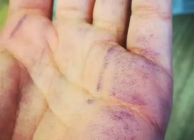 多功能显色剂 ——茚三酮(ninhydrin)_反应