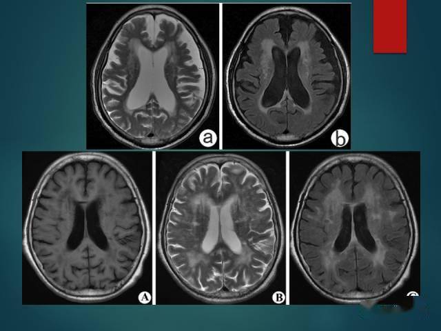 脫髓鞘疾病腔隙性腦梗死與血管周圍間隙的鑑別診斷