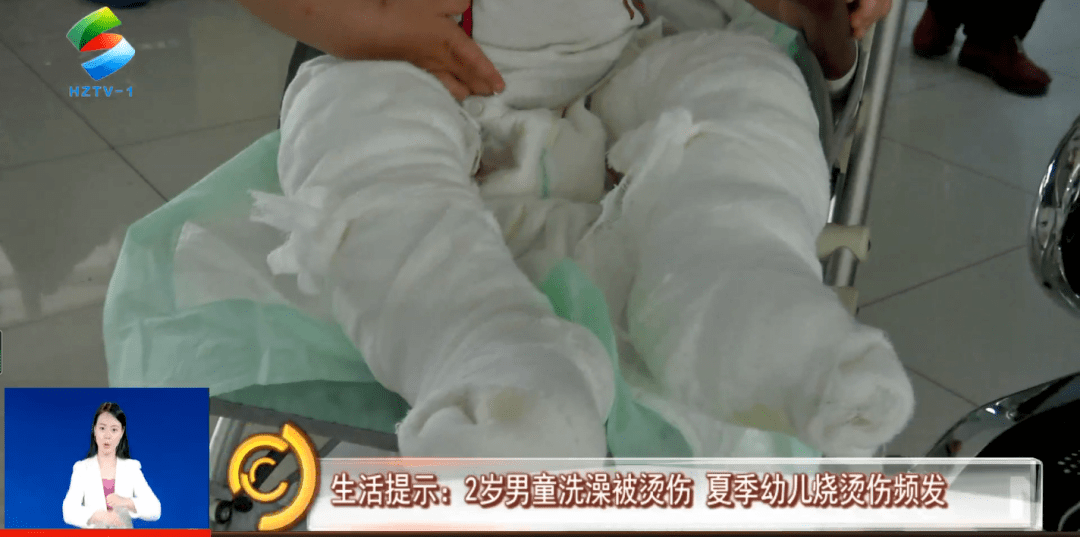 生活提示:2岁男童洗澡被烫伤 夏季幼儿烧烫伤频发