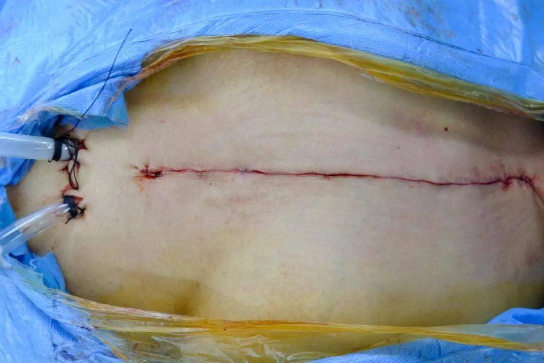 钙化上皮瘤手术后图片图片