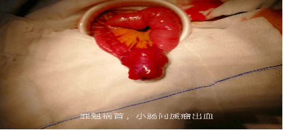 大小约 3*2 cm,考虑间质瘤出血,遂行小肠段间质瘤切除,空肠空肠吻合术