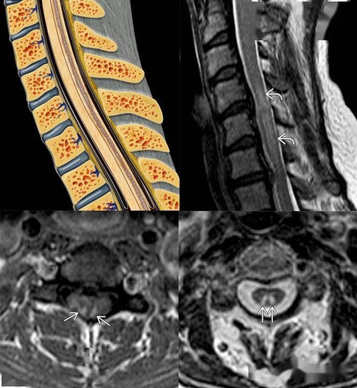 17 种脊髓病变影像解读,你 get 了吗
