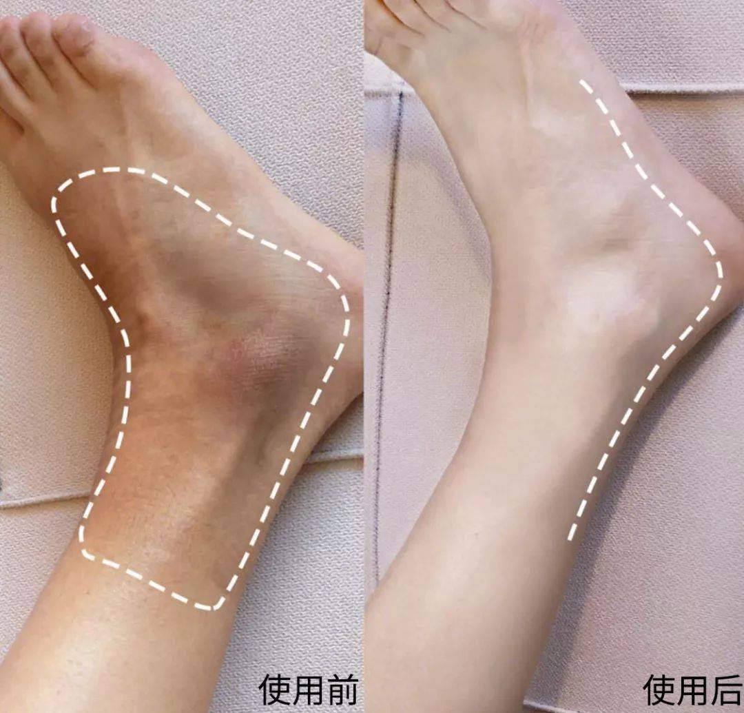 有鸡皮肤不能穿裙子凉鞋(腿上有鸡皮肤想穿裙子怎么办)