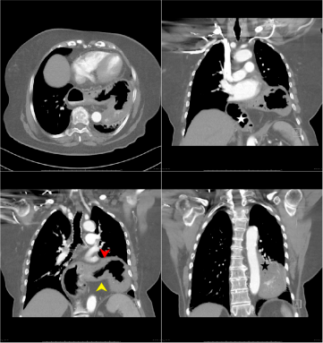 一文读懂急性胃痛 CT 检查表现_胃壁