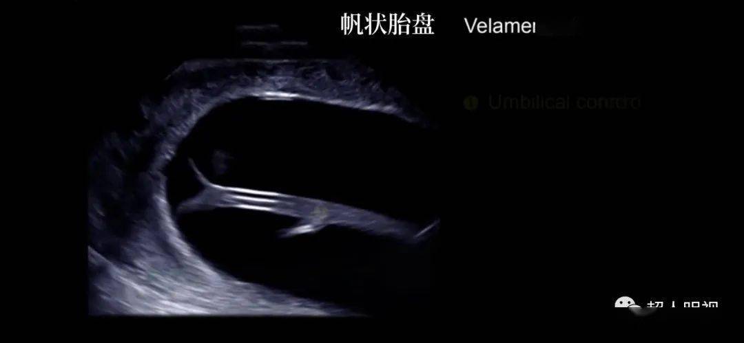 精细图解帆状胎盘等