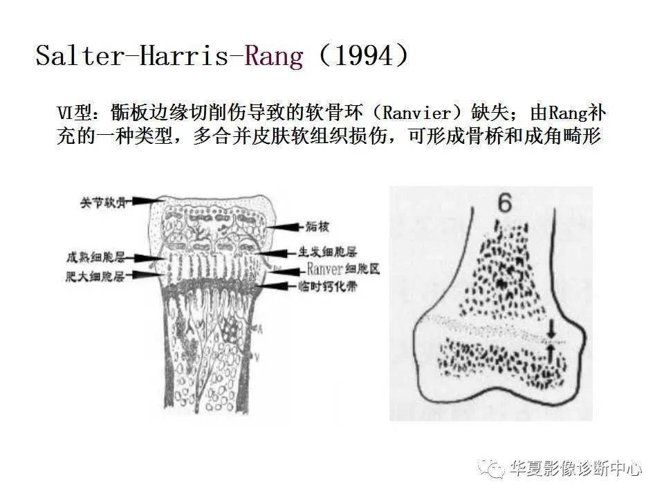 影像基础儿童骨骺损伤影像学分型