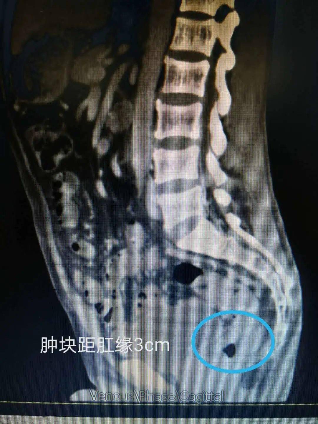 超低位直腸癌肛門還保得住嗎