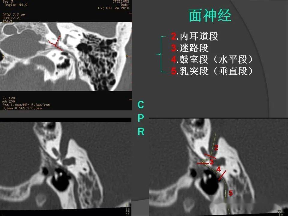 颞骨断层解剖及ct三维重建