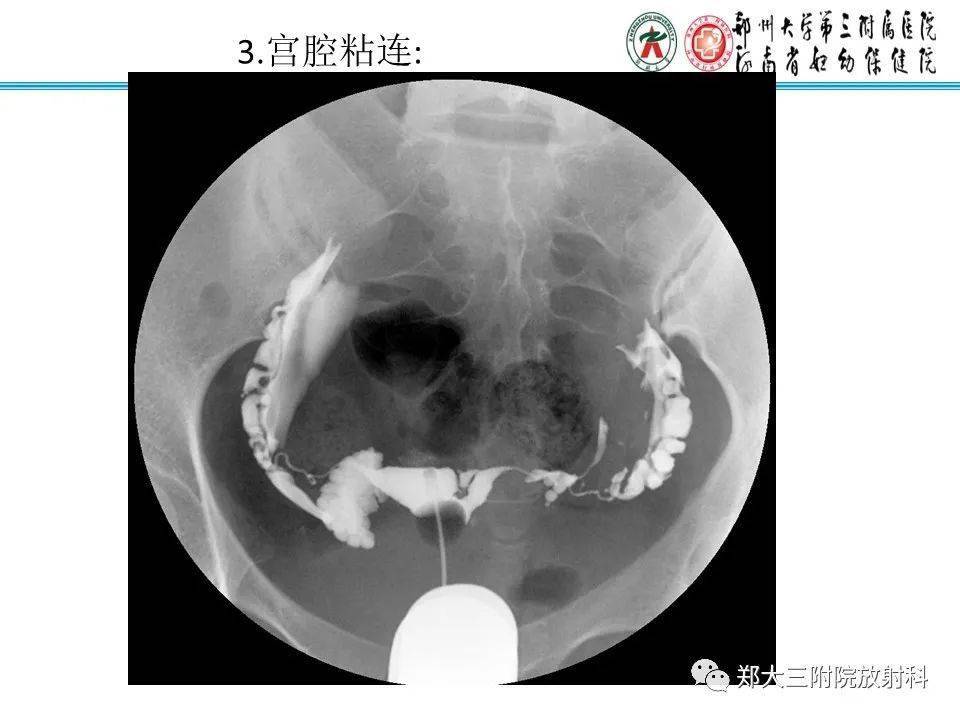 子宫输卵管造影检查的临床应用