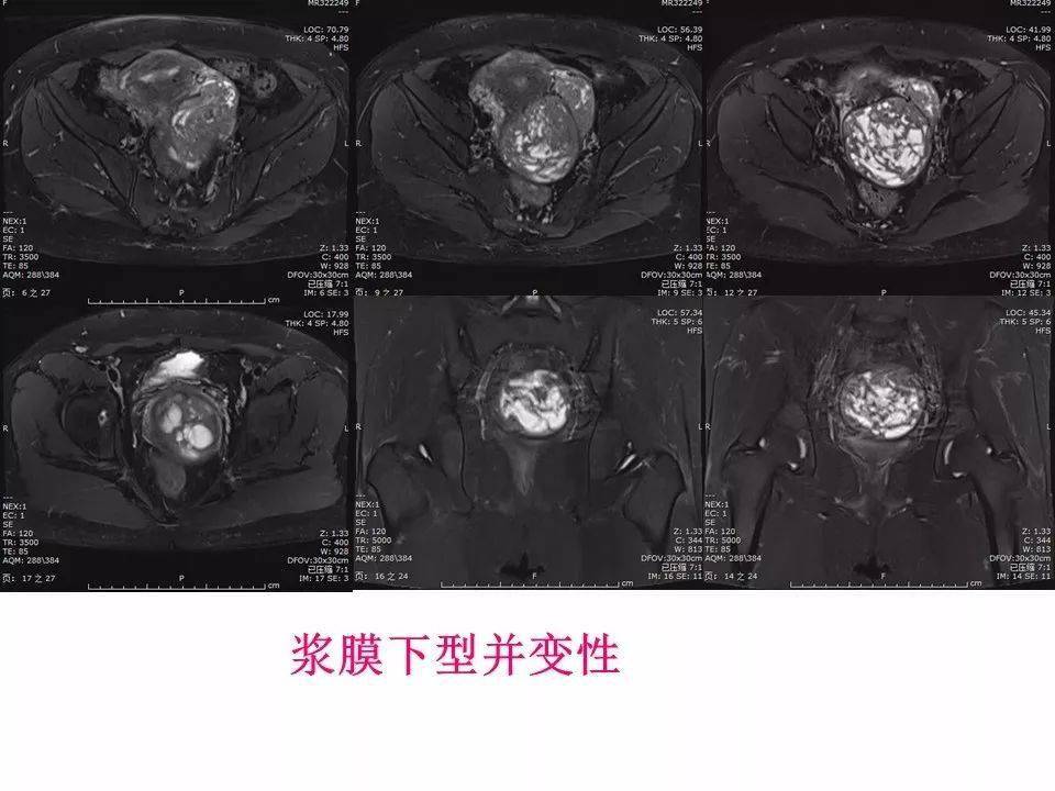 子宫常见肿瘤的mri表现