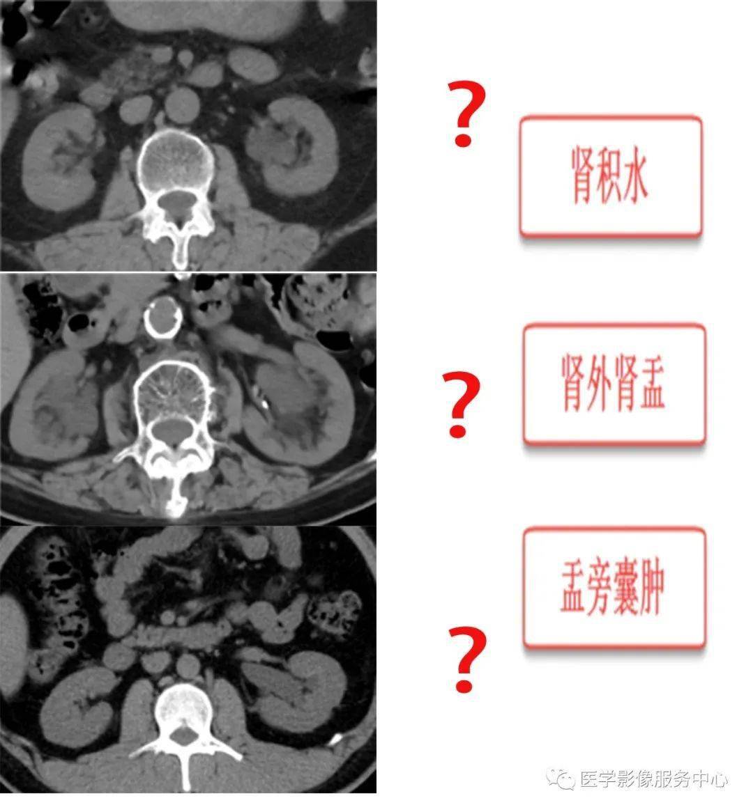 肾积水ct图片怎么看图片