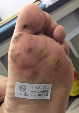 这种"脚钉",斩草要除根_皮肤