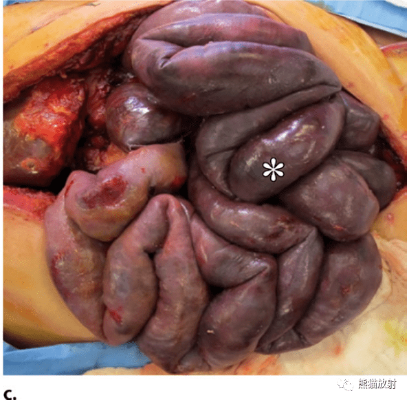 12种急性小肠疾病ct表现你知道多少