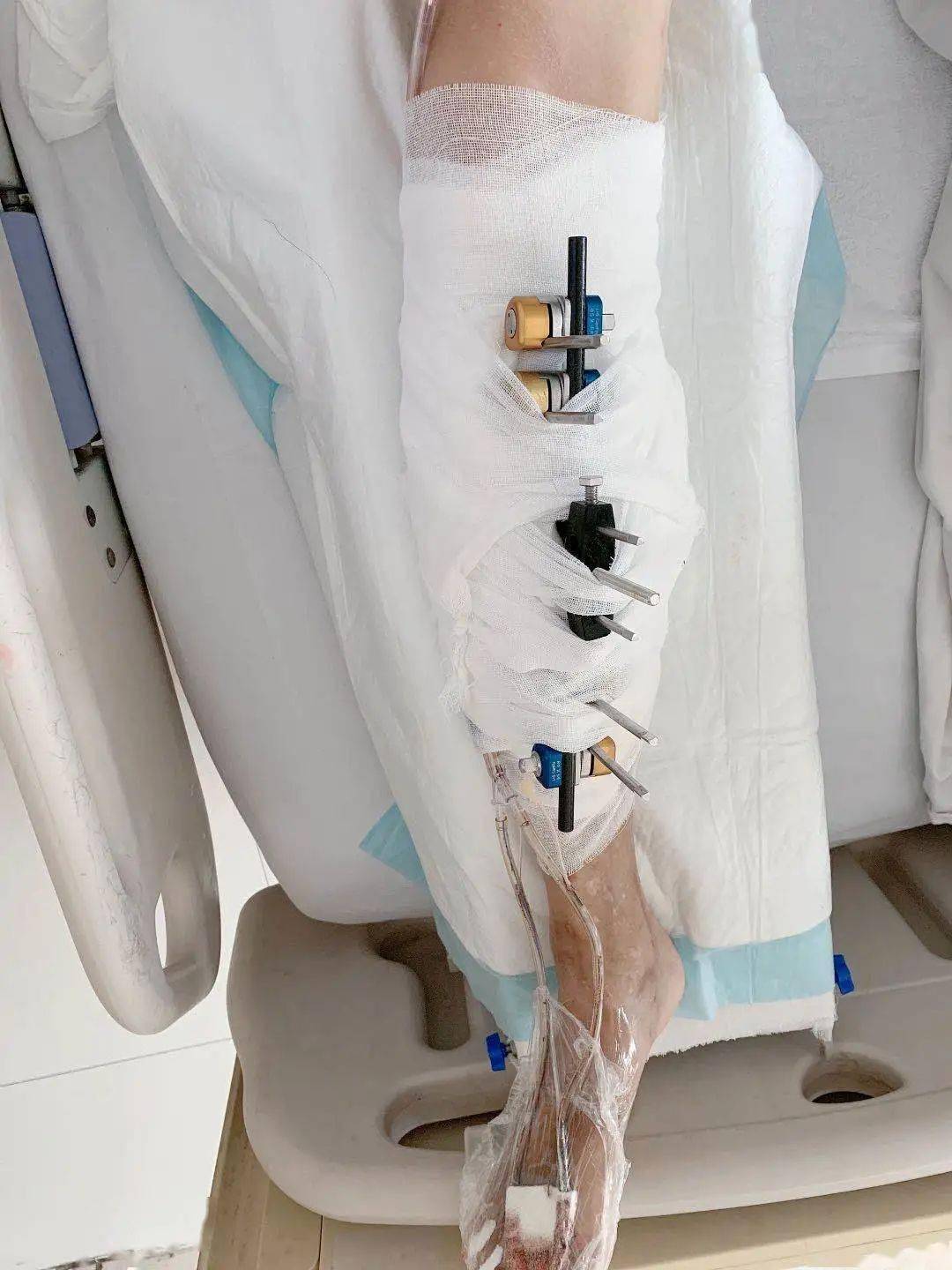 医院动态免除截肢痛苦陕健医二一五医院骨四科成功救治一名糖尿病足