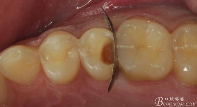 术前x光片,确定龋洞位置大小然而是不可能的,只能尽力去采用微创的