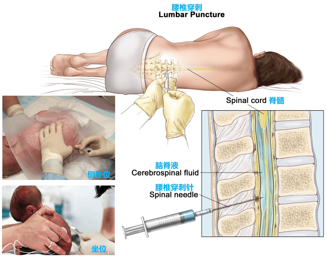 正因为脑脊液在不停循环,所以通过腰椎穿刺获取脑脊液标本进行化验,有