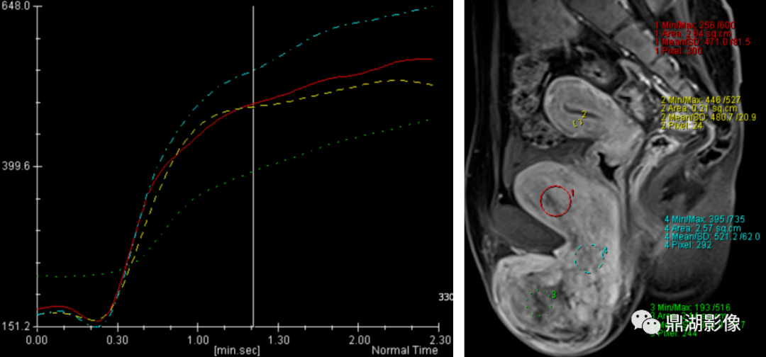 侵袭性血管黏液瘤影像诊断分析