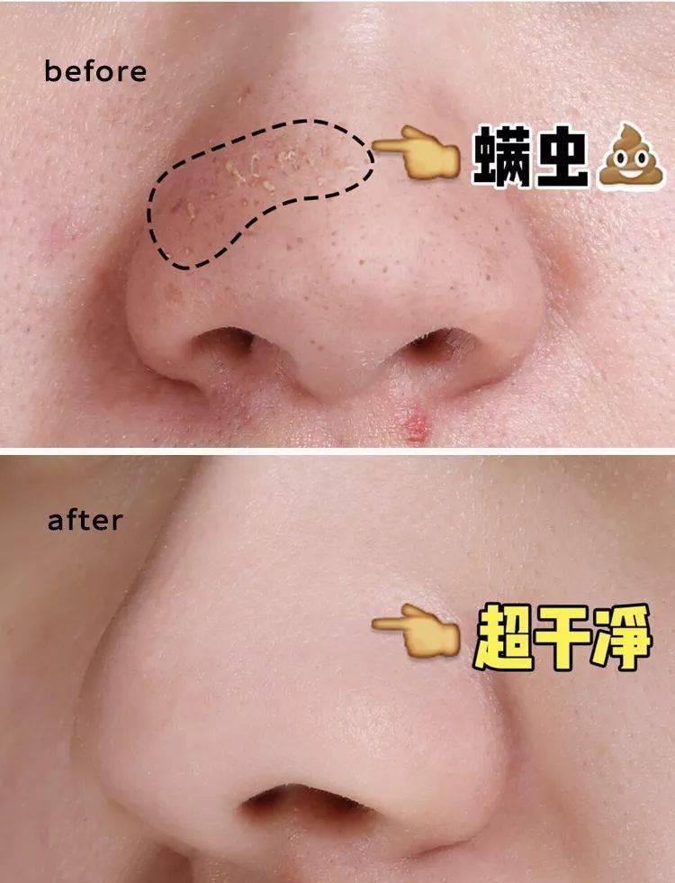 拒绝螨虫脸洗脸加点它10秒揉出毛孔里的螨虫痘痘黑头全没了