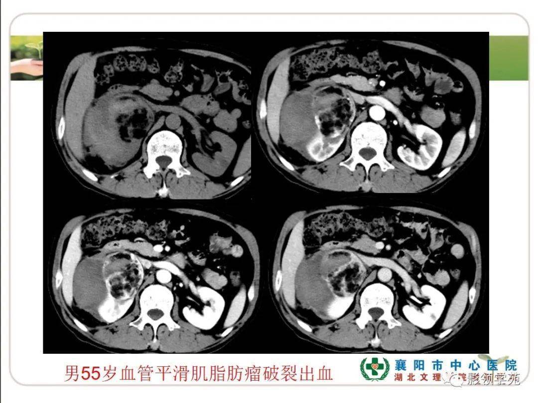 经典肾脏肿瘤影像回顾