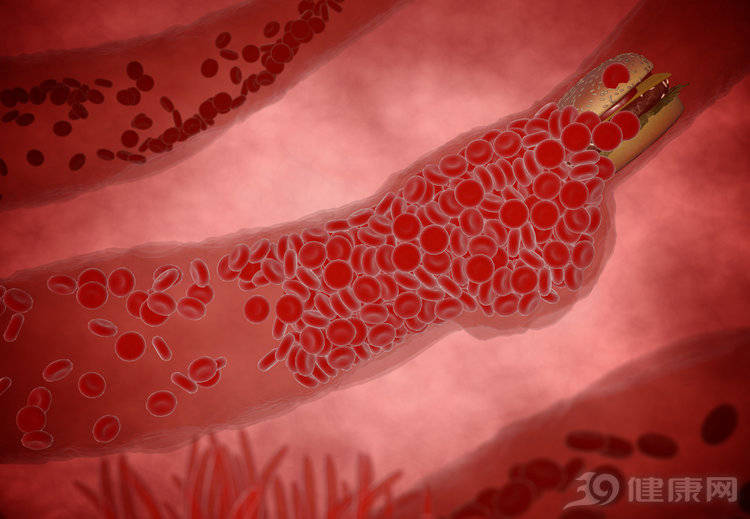 红色血栓:当混合血栓逐渐增大之后,阻塞管腔周围的局部血流停止之后