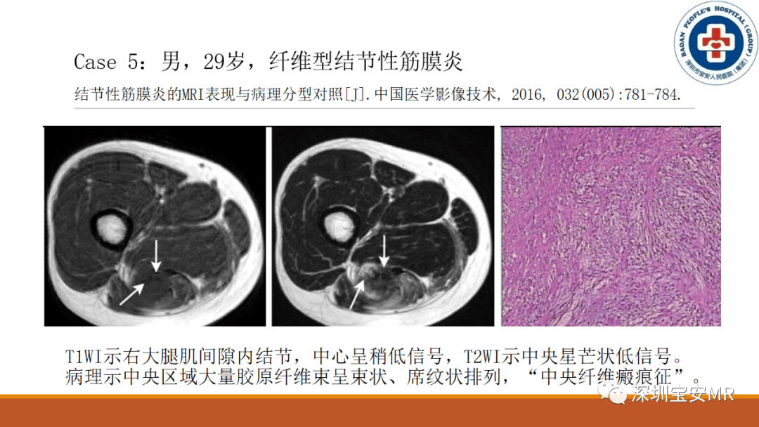 结节性筋膜炎临床与影像
