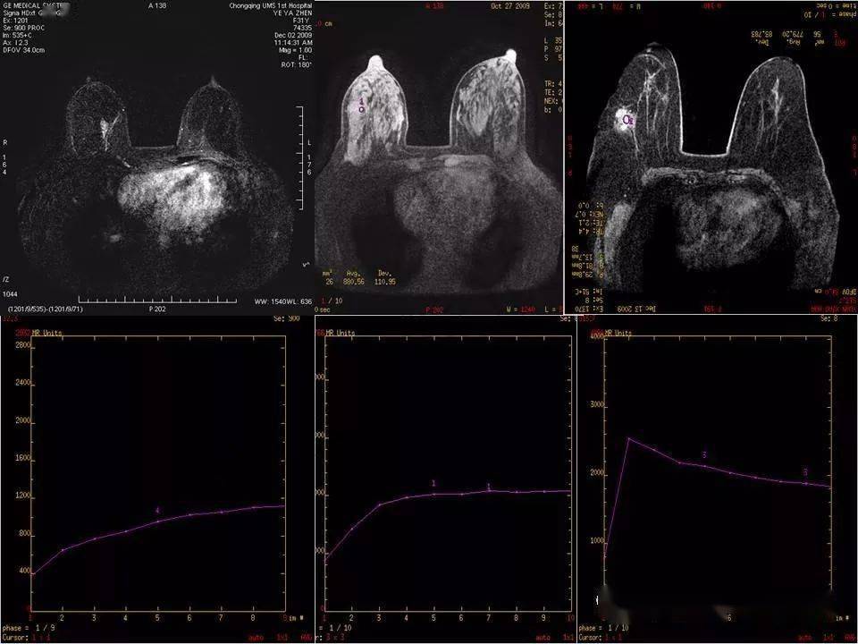 乳腺癌磁共振图片图片