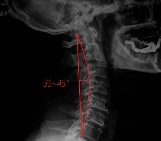 正常颈椎侧面图图片