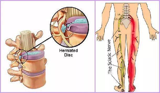 腰椎養護丨關於腰椎間盤突出的九大誤區