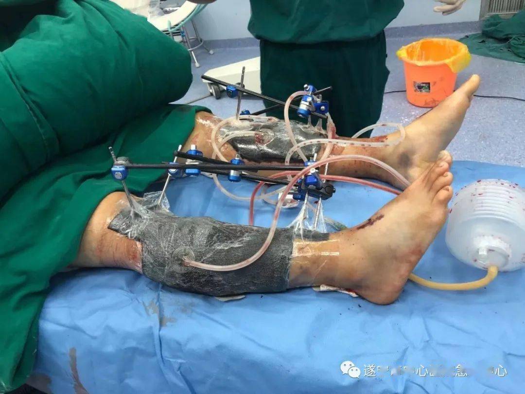 惊险我院多学科创伤团队又成功救治一例危重创伤患者
