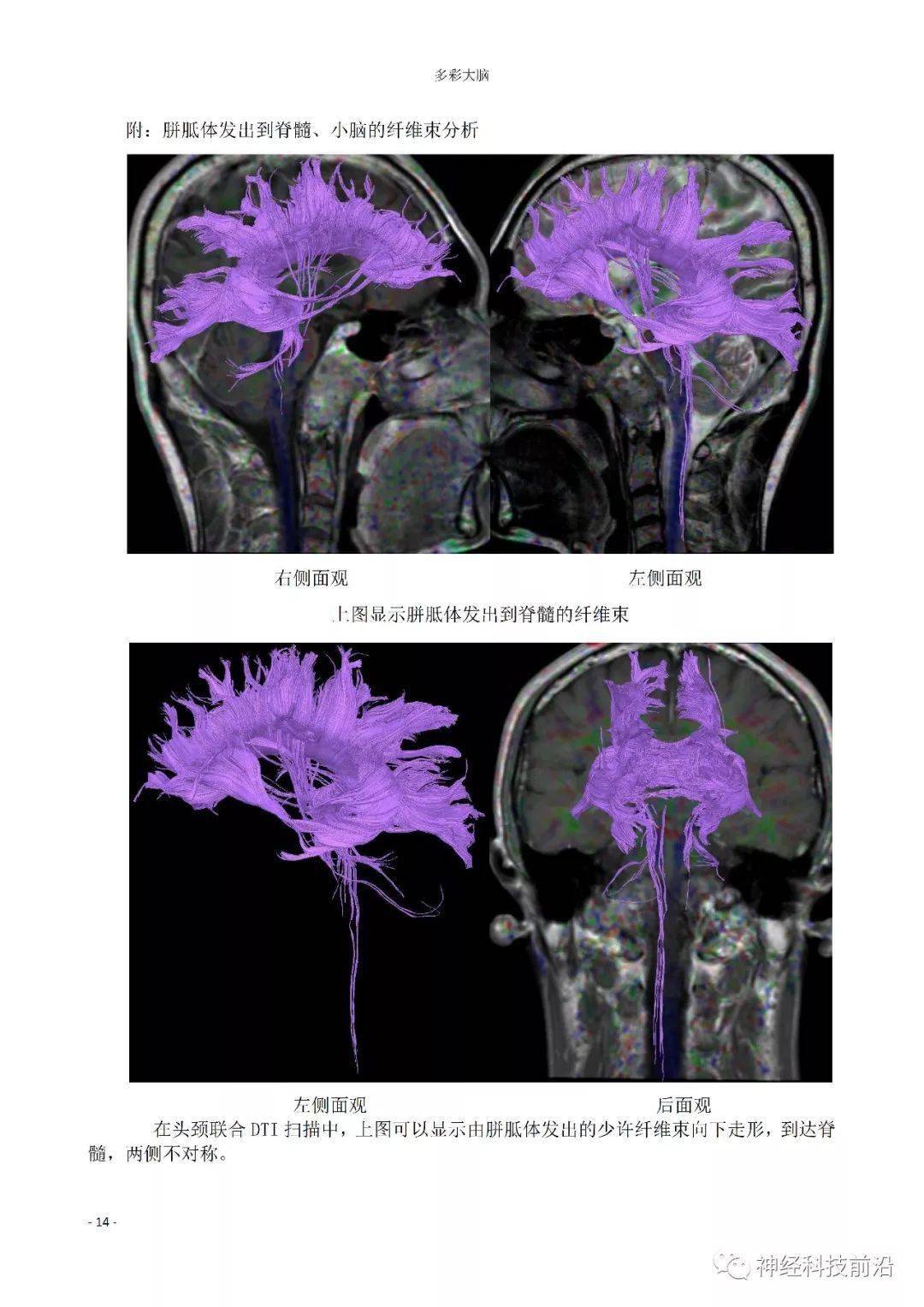 超精致12对颅神经dti纤维束成像
