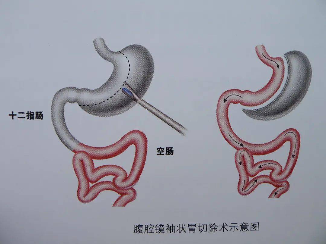 腹腔镜手术原理示意图图片
