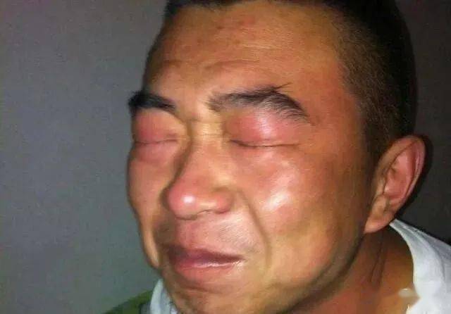 电焊打了眼睛最好最快,最方便的办法是什么?