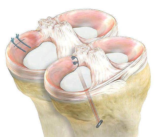 半月板撕裂后少行走能促进愈合医生辟谣与您详述伤后该咋办
