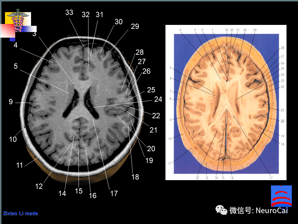 影像解剖 | 腦局部解剖與功能圖譜_頭皮