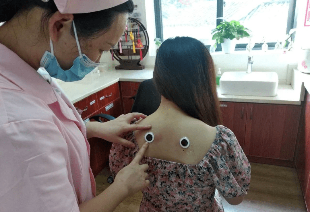 7月16日初伏贴开始了,阳朔县妇幼保健院中医科邀您来贴三伏贴!