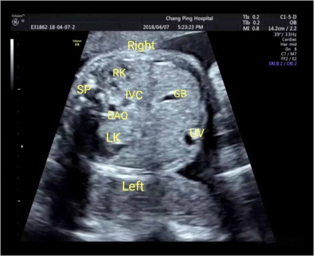 超声典型病例胎儿法洛四联症合并右位主动脉弓