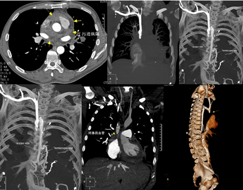 沿途显示双侧肋间后静脉,食管静脉早显或增宽.
