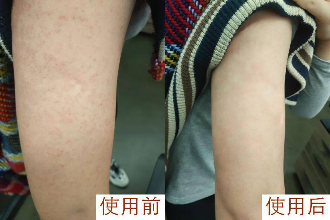 包含鸡皮疙瘩产生和消失的时间的词条
