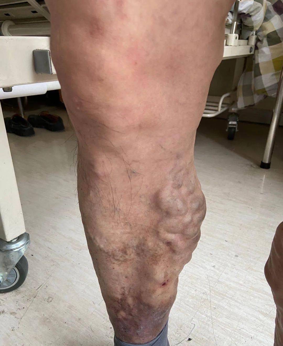 腿肿得像皮肤里塞进了棉花,几十年没穿过短裤_大伯